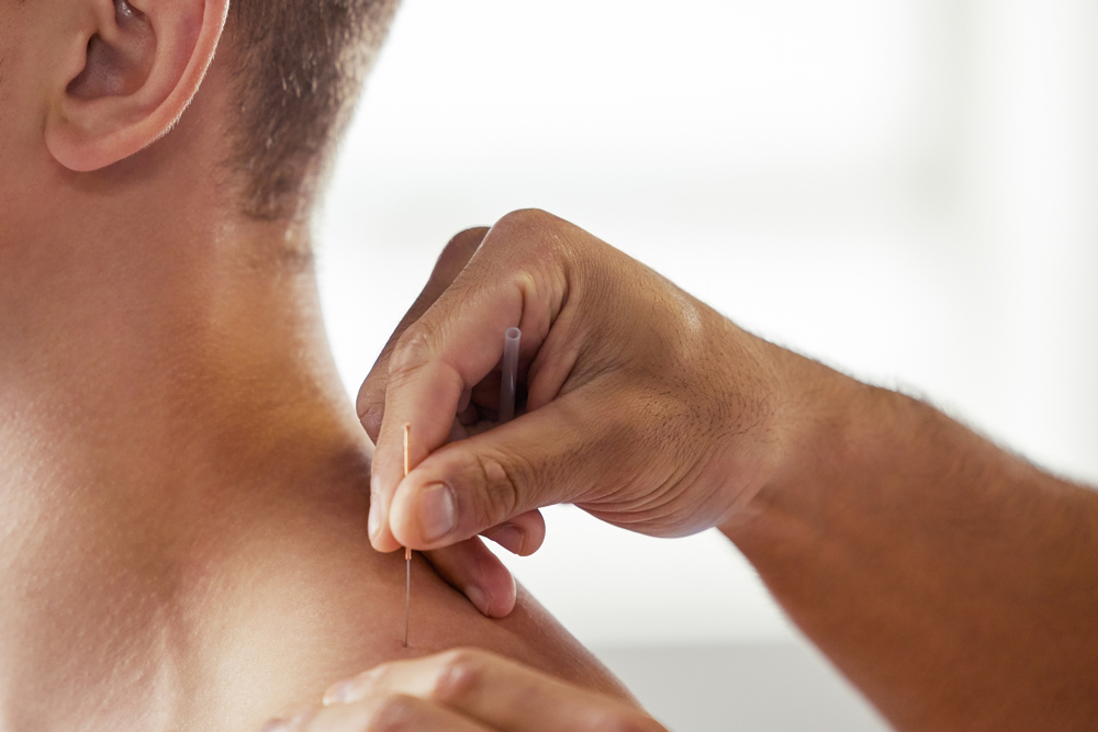 Acupuncture Services
