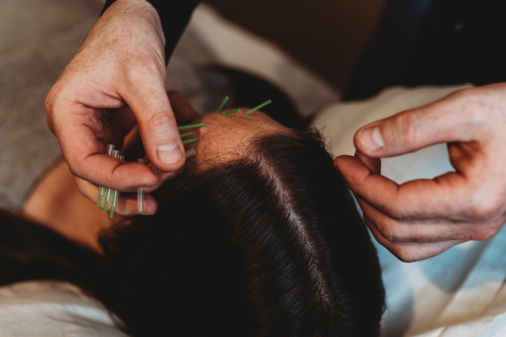 Facial Acupuncture in Aldergrove