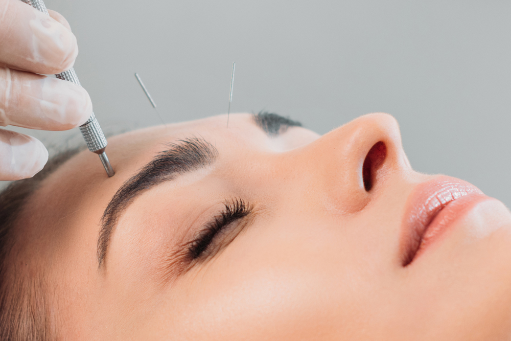 Facial Acupuncture Services