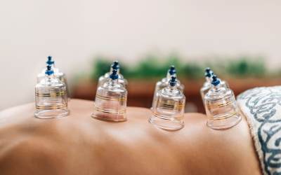 Why Does Cupping Cause Bruising?